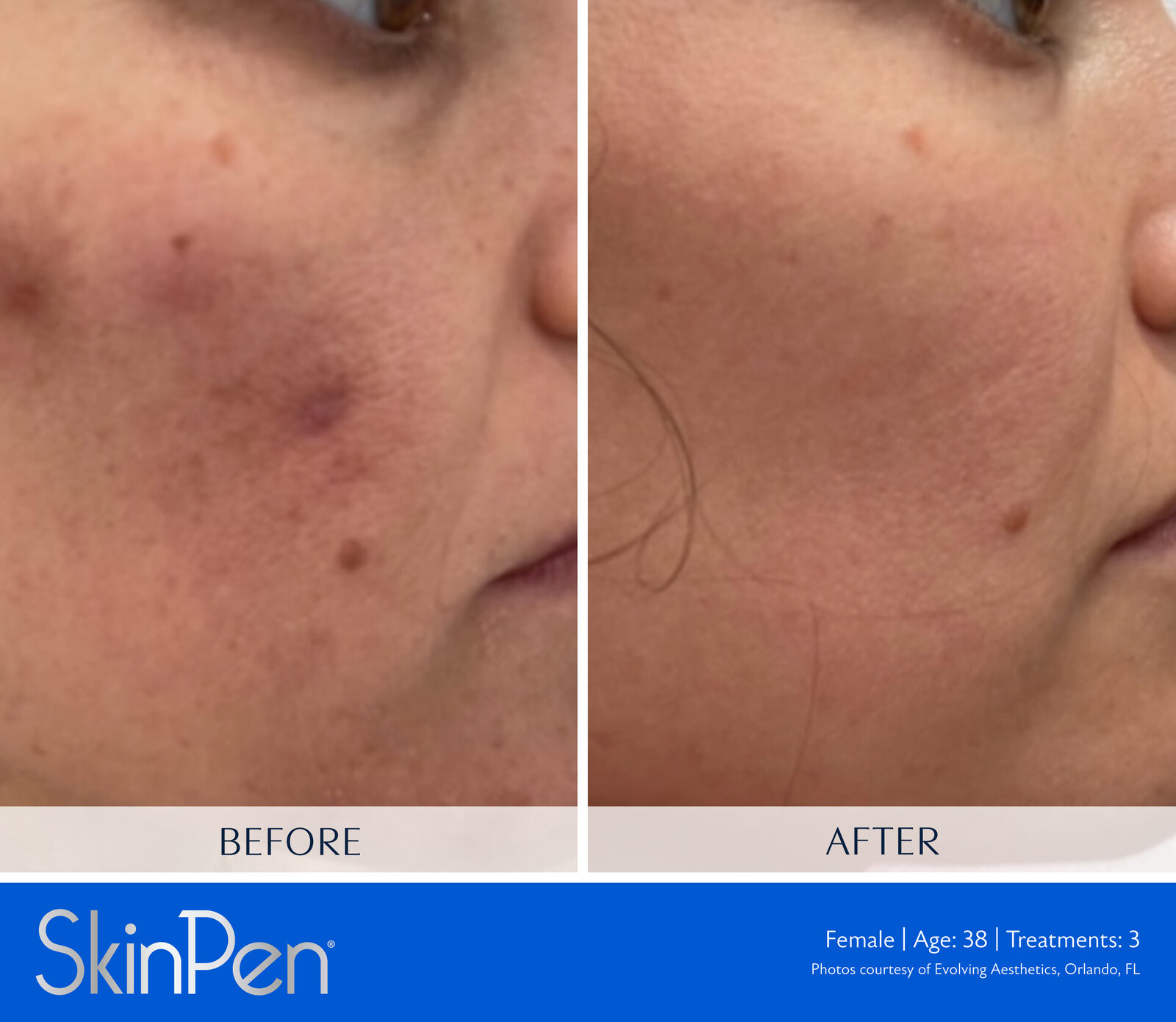 SkinPen before and after, acne scarring, female patient age 38, three treatments