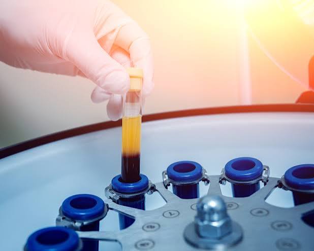 Spun PRP sample separated into platelet-rich plasma for in-home hair restoration in Palm Beach County